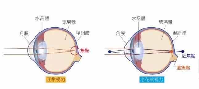 白內(nèi)障和老花眼區(qū)別，老花眼發(fā)病率正呈現(xiàn)年輕化趨勢